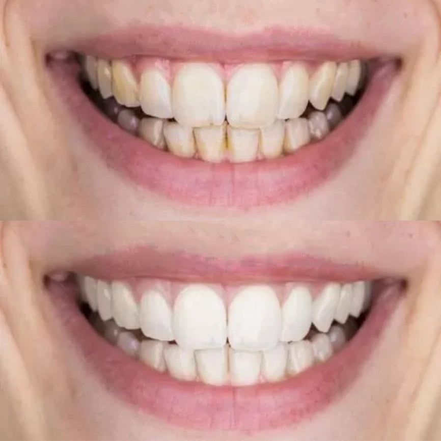 DENTclear® Ultraschall-Zahnreiniger